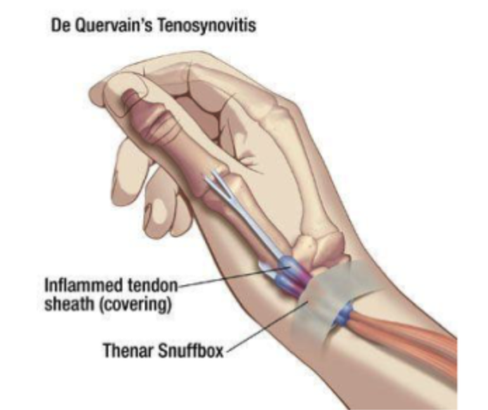 De Quervain's Tenosynovitis