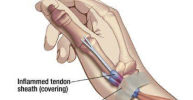 De Quervain's Tenosynovitis image