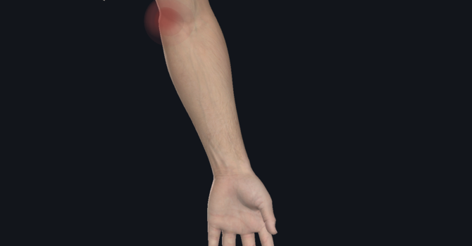 Golfer's Elbow