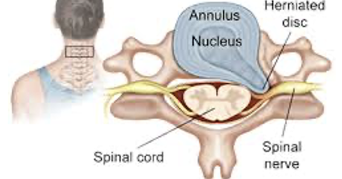 Disc Herniations