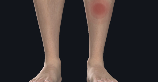 Medial Tibial Stress Syndrome, aka Shin Splints